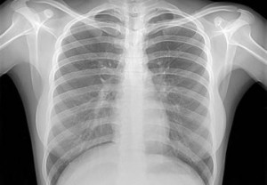 X-rays 